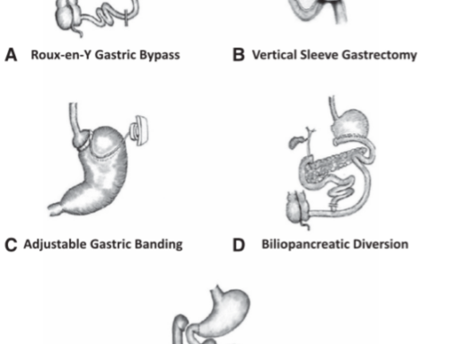 The effects of bariatric surgery; Weight loss and beyond