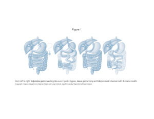 Illustration showing four stages of bariatric surgery: adjustable gastric banding, roux-en-y gastric bypass, sleeve gastrectomy, and biliopancreatic diversion with duodenal switch.